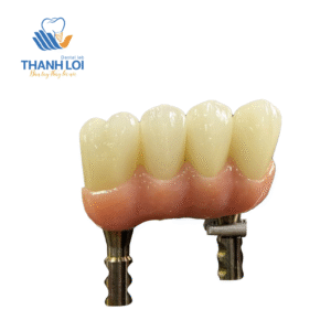 Cầu Phục hình bắt vis từ đơn lẻ đến 2-3 đơn vị trên Multi (Ko cần Cylinder)