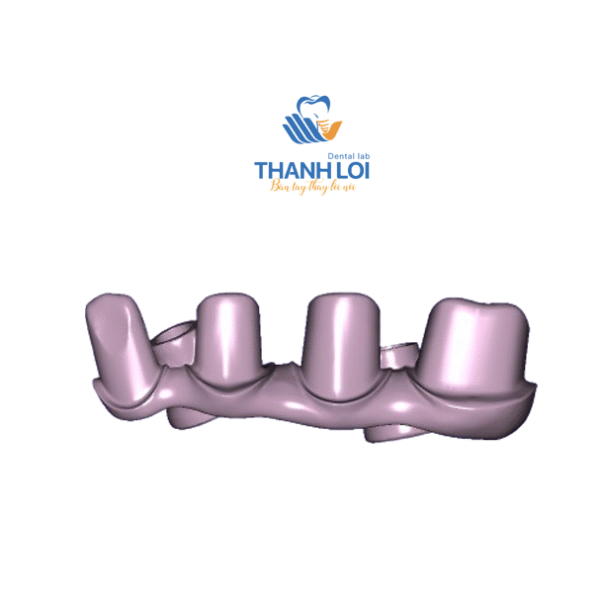 Cầu Phục hình bắt vis từ đơn lẻ đến 2-3 đơn vị trên Multi (Ko cần Cylinder) - Ảnh 2